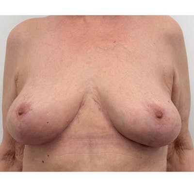 Breast Lift Before & After Gallery - Patient 423296 - Image 2
