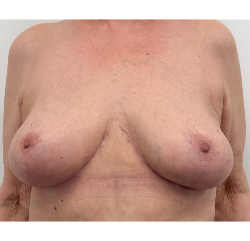 Breast Lift Before & After Gallery - Patient 423296 - Image 2