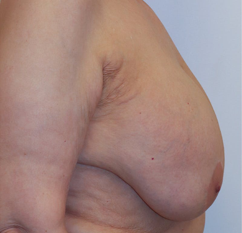 Breast Lift Before & After Gallery - Patient 423296 - Image 3