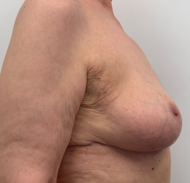 Breast Lift Before & After Gallery - Patient 423296 - Image 4