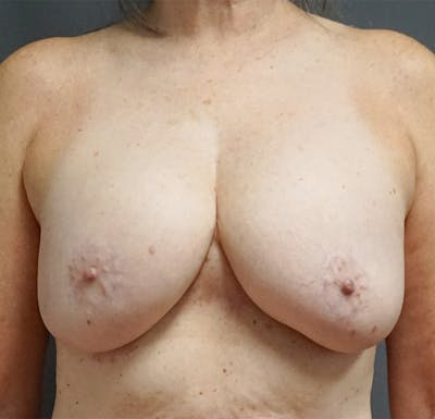 Breast Lift Before & After Gallery - Patient 239447 - Image 1