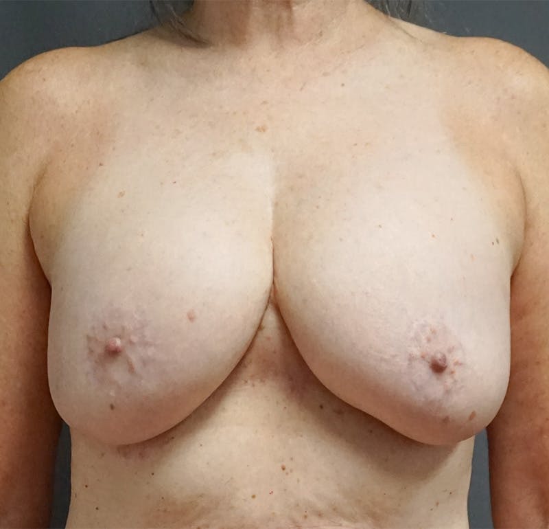 Breast Lift Before & After Gallery - Patient 239447 - Image 1