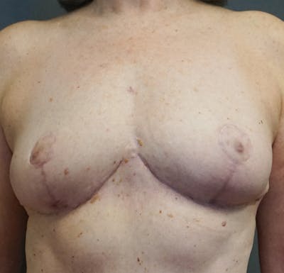 Breast Lift Before & After Gallery - Patient 239447 - Image 2