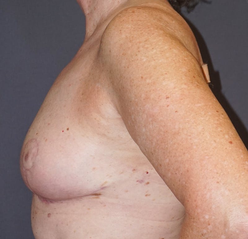 Breast Lift Before & After Gallery - Patient 239447 - Image 3