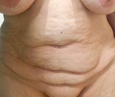 Tummy Tuck Before & After Gallery - Patient 321176 - Image 1