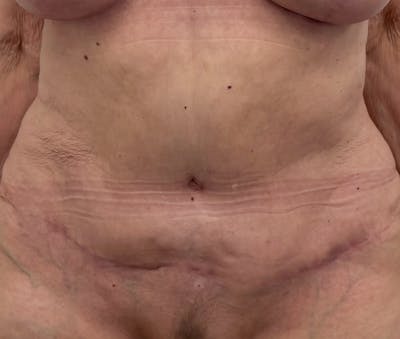Tummy Tuck Before & After Gallery - Patient 321176 - Image 2