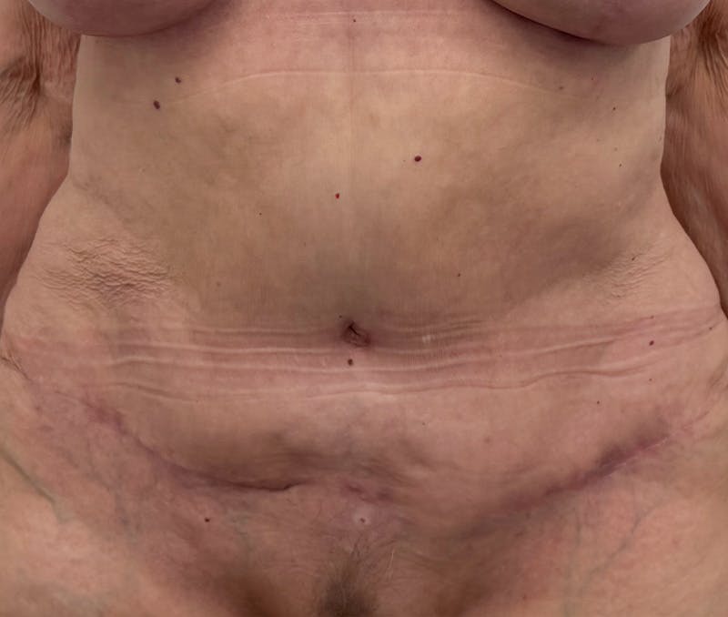 Tummy Tuck Before & After Gallery - Patient 321176 - Image 2