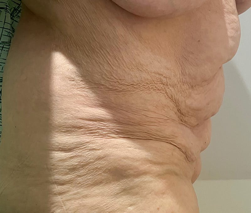 Tummy Tuck Before & After Gallery - Patient 321176 - Image 3