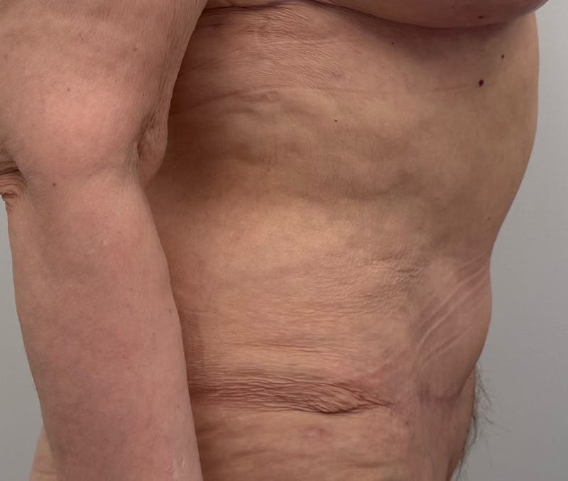 Tummy Tuck Before & After Gallery - Patient 321176 - Image 4