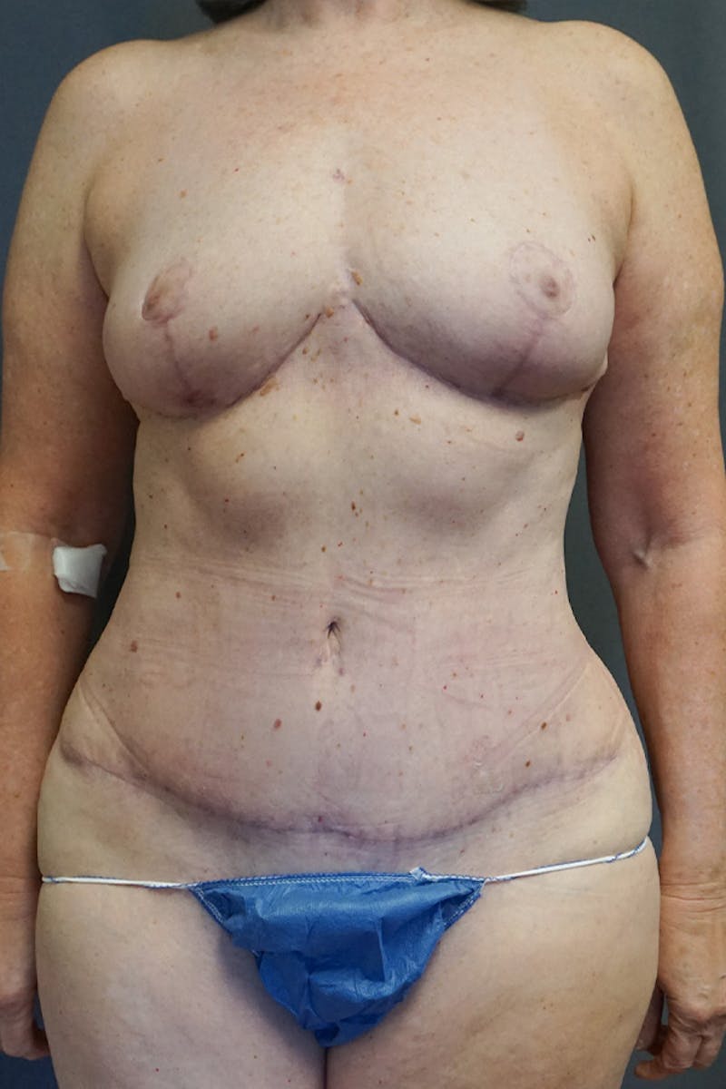 Mommy Makeover Before & After Gallery - Patient 358221 - Image 2