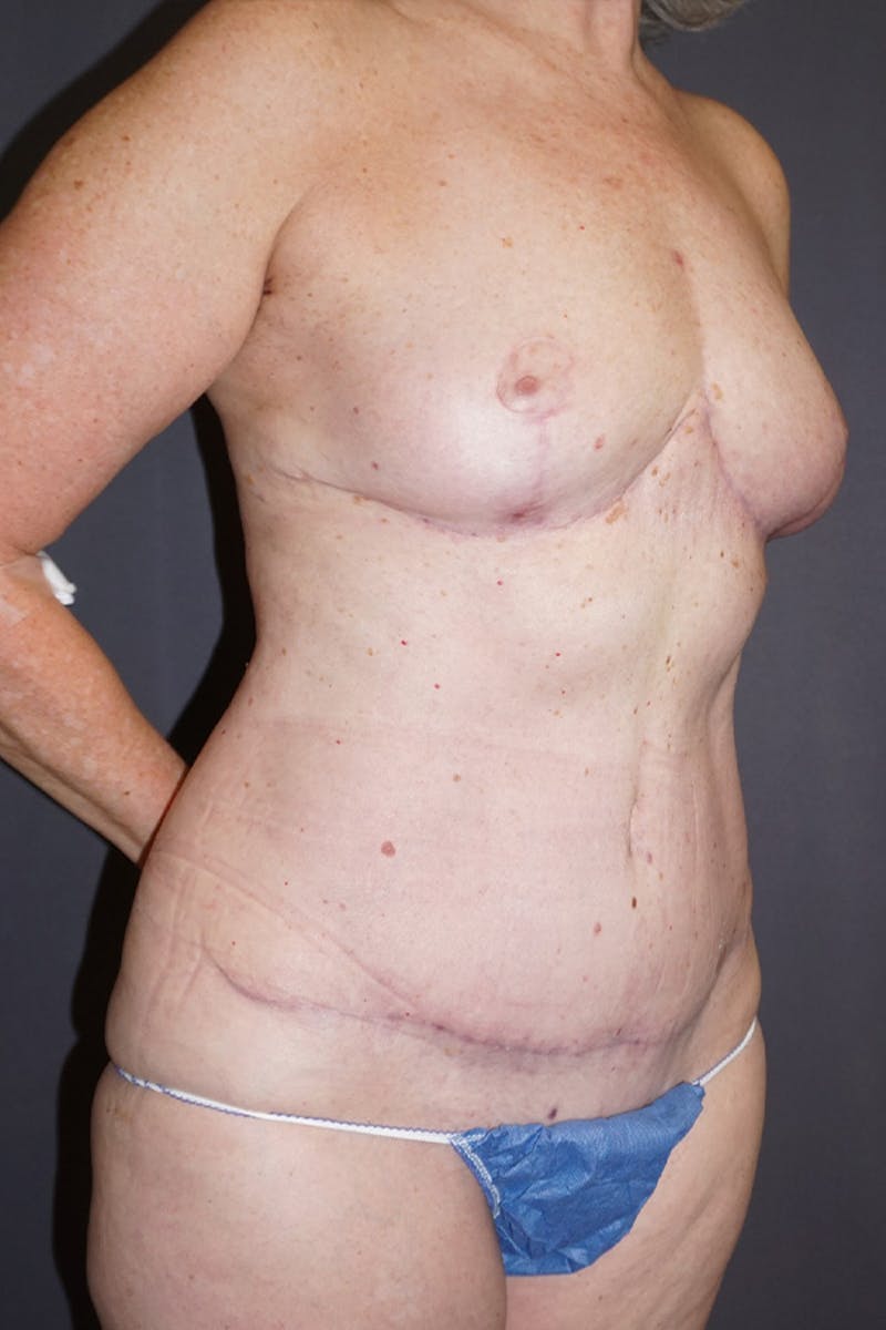 Mommy Makeover Before & After Gallery - Patient 358221 - Image 4