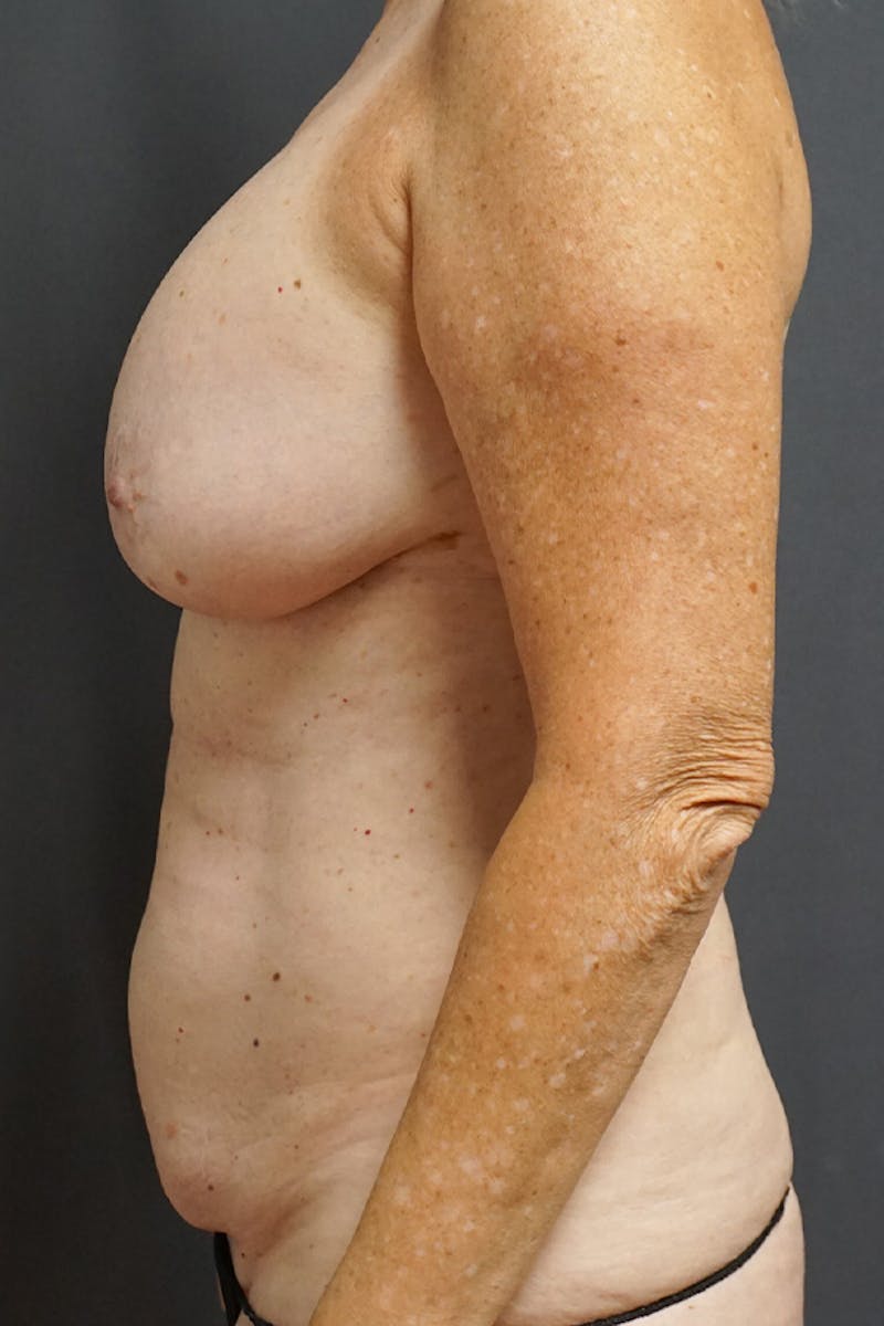 Mommy Makeover Before & After Gallery - Patient 358221 - Image 5