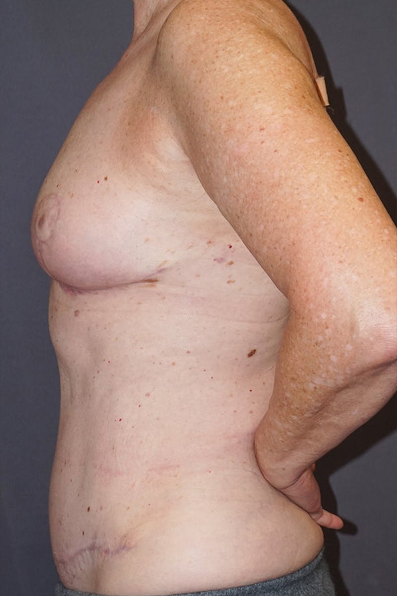 Mommy Makeover Before & After Gallery - Patient 358221 - Image 6