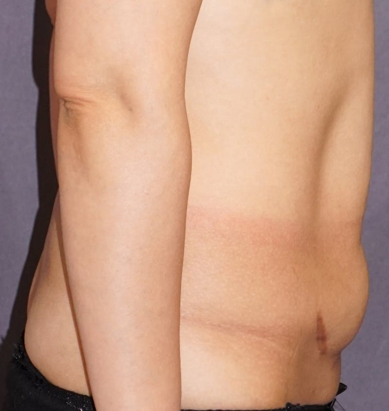 Tummy Tuck Before & After Gallery - Patient 229870 - Image 1