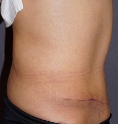 Tummy Tuck Before & After Gallery - Patient 229870 - Image 2