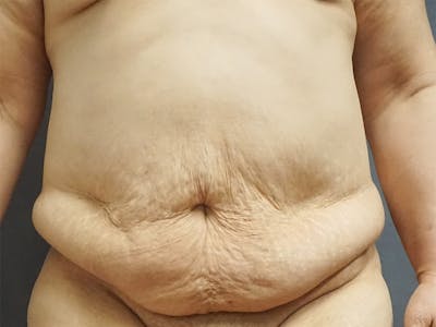 Tummy Tuck Before & After Gallery - Patient 420121 - Image 1