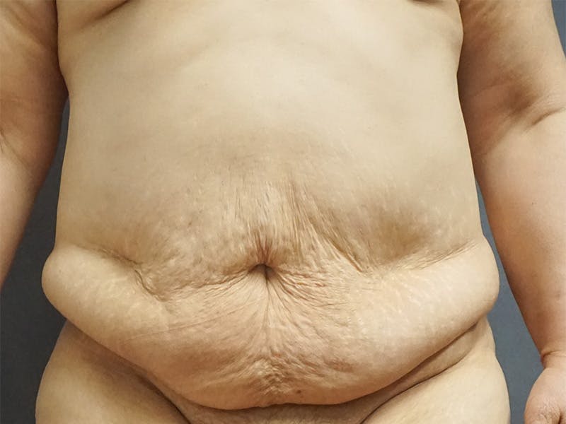 Tummy Tuck Before & After Gallery - Patient 420121 - Image 1