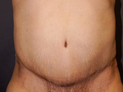 Tummy Tuck Before & After Gallery - Patient 420121 - Image 2