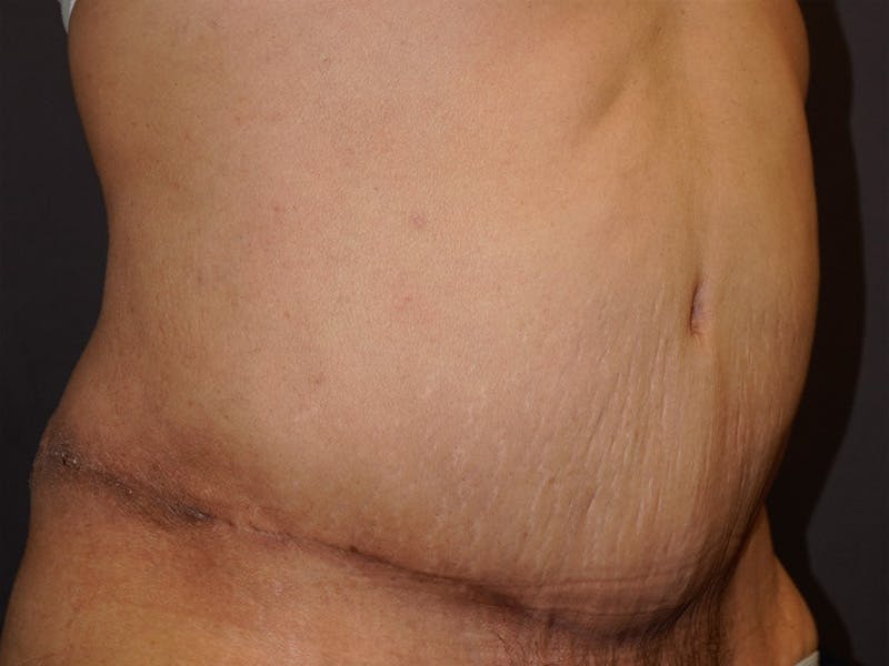 Tummy Tuck Before & After Gallery - Patient 420121 - Image 4