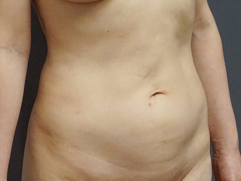 Tummy Tuck Before & After Gallery - Patient 307404 - Image 1