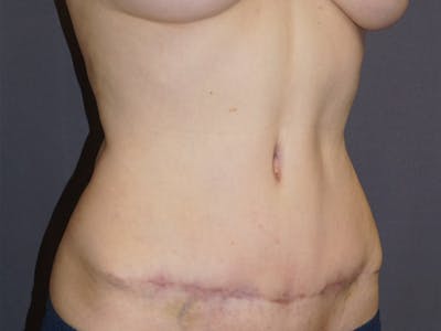 Tummy Tuck Before & After Gallery - Patient 307404 - Image 2
