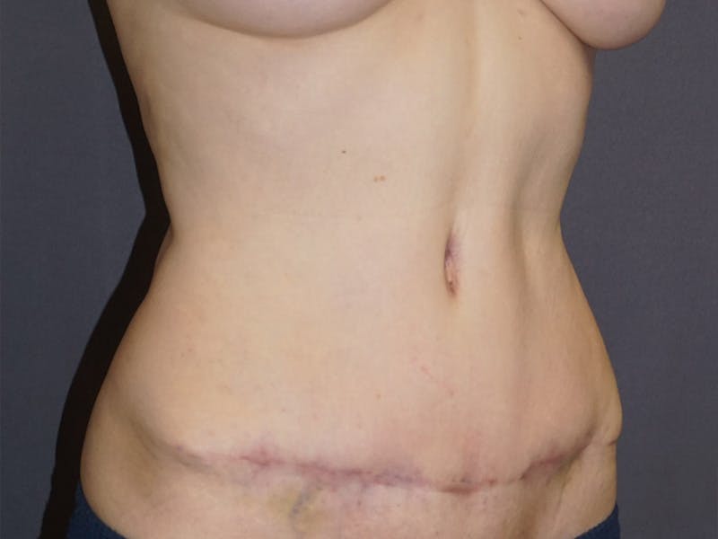 Tummy Tuck Before & After Gallery - Patient 307404 - Image 2