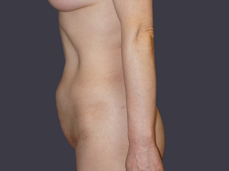 Tummy Tuck Before & After Gallery - Patient 307404 - Image 3