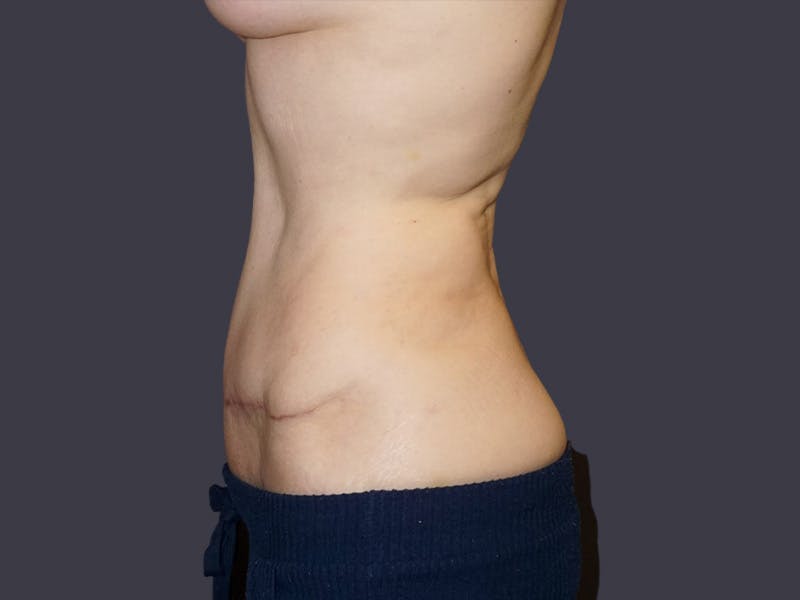 Tummy Tuck Before & After Gallery - Patient 307404 - Image 4