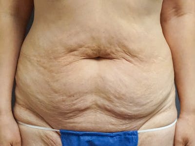 Tummy Tuck Before & After Gallery - Patient 297031 - Image 1