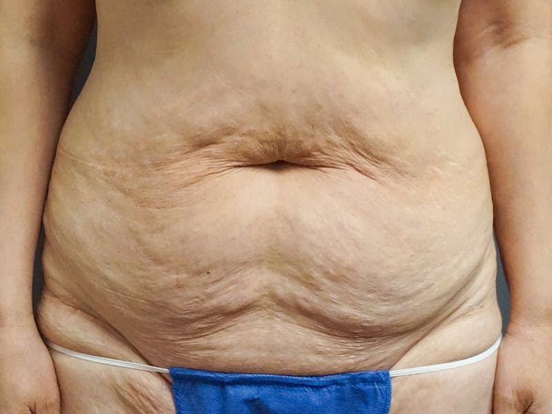 Tummy Tuck Before & After Gallery - Patient 297031 - Image 1