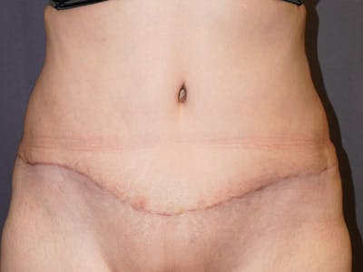 Tummy Tuck Before & After Gallery - Patient 297031 - Image 2
