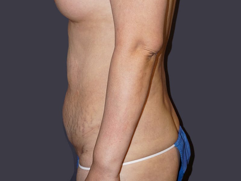 Tummy Tuck Before & After Gallery - Patient 297031 - Image 3