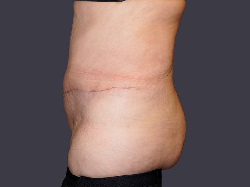 Tummy Tuck Before & After Gallery - Patient 297031 - Image 4