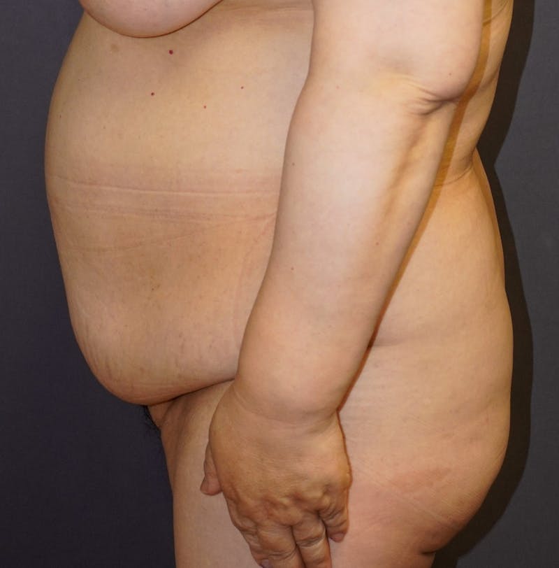 Tummy Tuck Before & After Gallery - Patient 391279 - Image 5