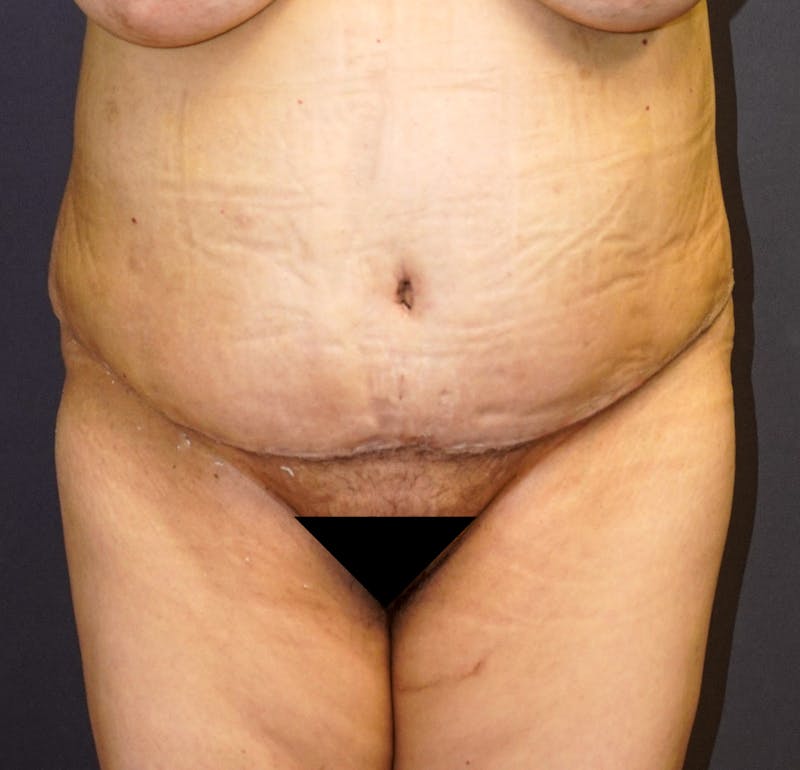 Tummy Tuck Before & After Gallery - Patient 391279 - Image 2