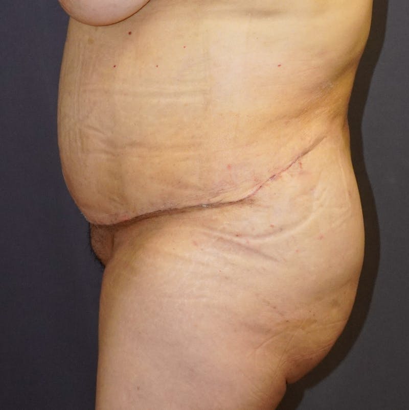 Tummy Tuck Before & After Gallery - Patient 391279 - Image 6