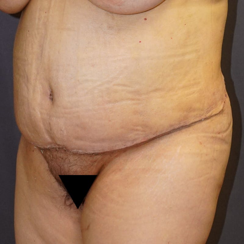Tummy Tuck Before & After Gallery - Patient 391279 - Image 4