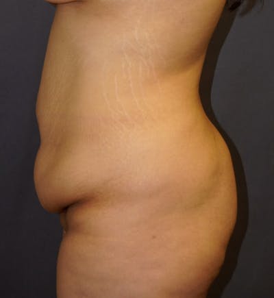 Tummy Tuck Before & After Gallery - Patient 266709 - Image 1