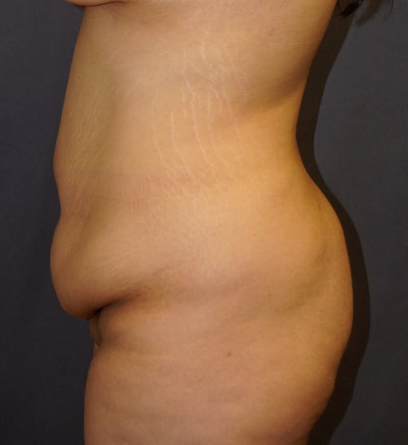 Tummy Tuck Before & After Gallery - Patient 266709 - Image 1