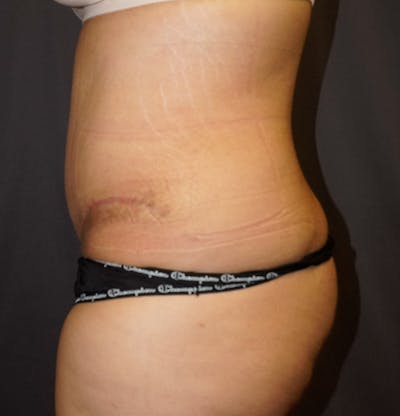 Tummy Tuck Before & After Gallery - Patient 266709 - Image 2