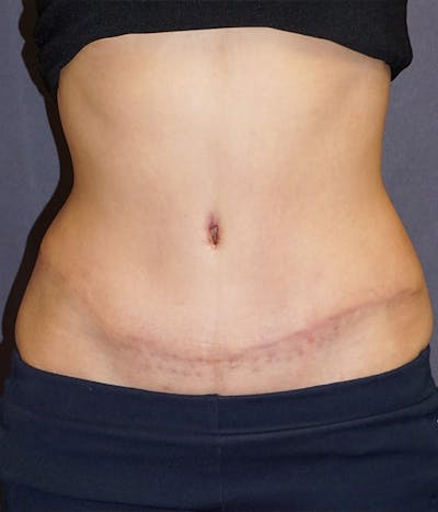 Tummy Tuck Before & After Gallery - Patient 410226 - Image 2
