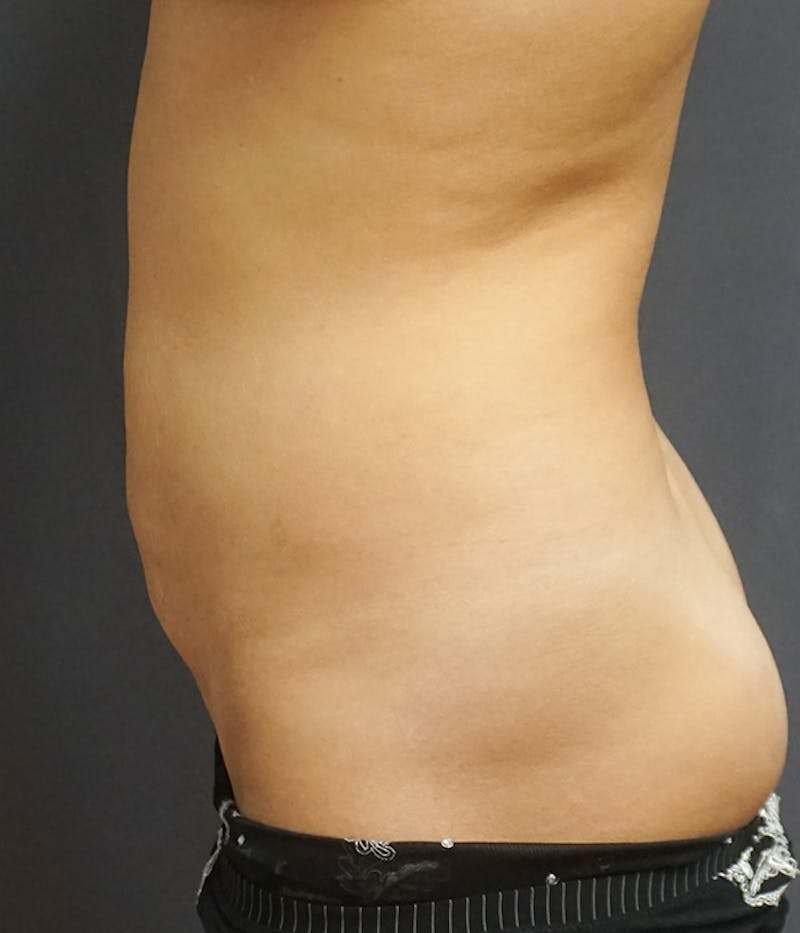 Tummy Tuck Before & After Gallery - Patient 410226 - Image 3