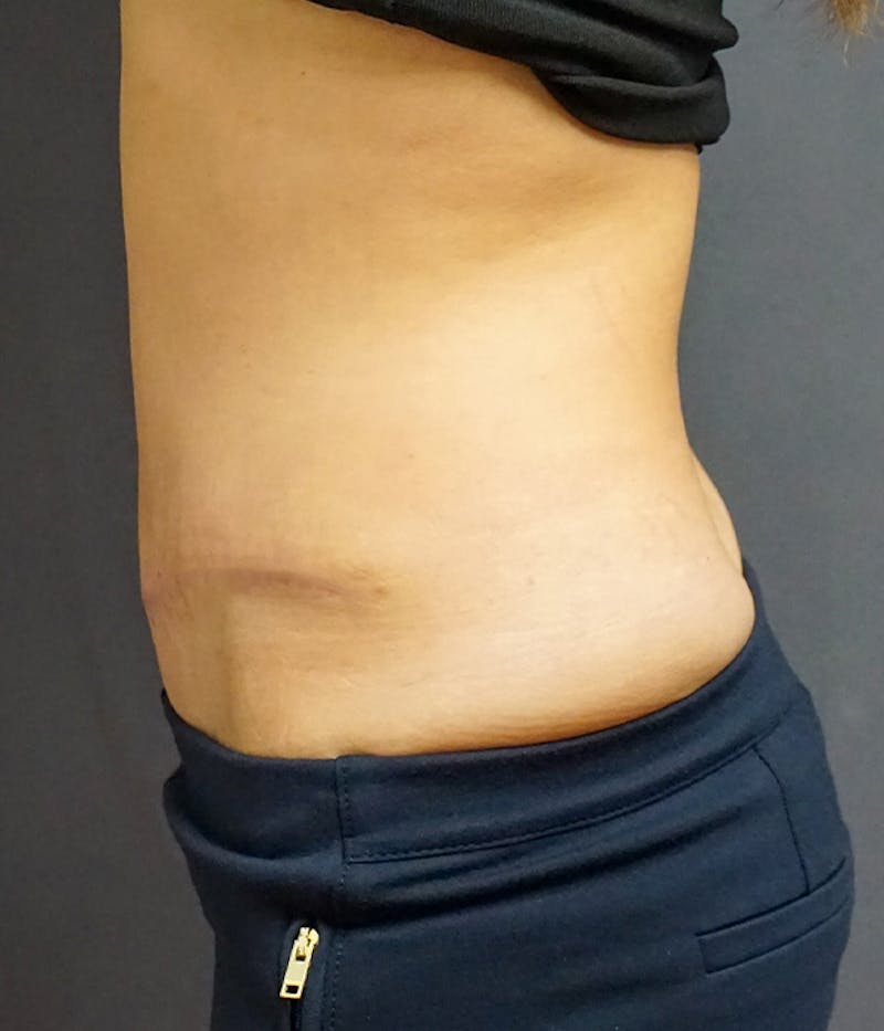 Tummy Tuck Before & After Gallery - Patient 410226 - Image 4