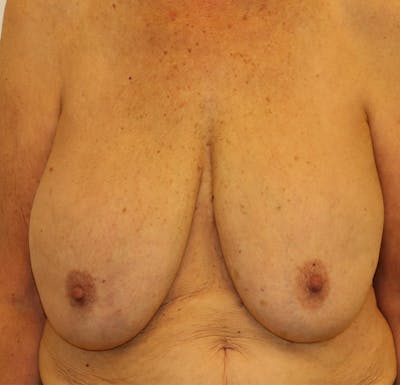 Breast Lift Before & After Gallery - Patient 323361 - Image 1