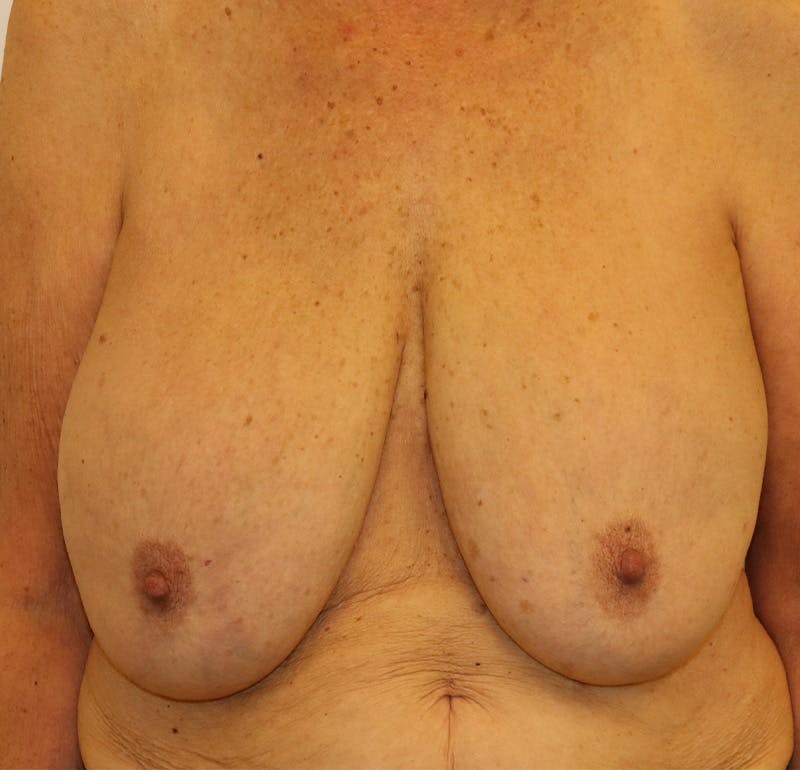 Breast Lift Before & After Gallery - Patient 323361 - Image 1