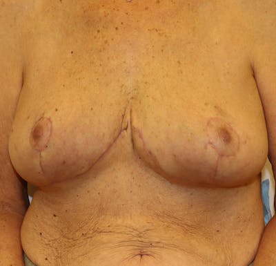 Breast Lift Before & After Gallery - Patient 323361 - Image 2