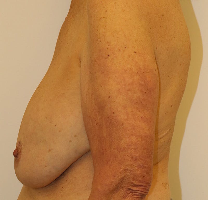 Breast Lift Before & After Gallery - Patient 323361 - Image 5