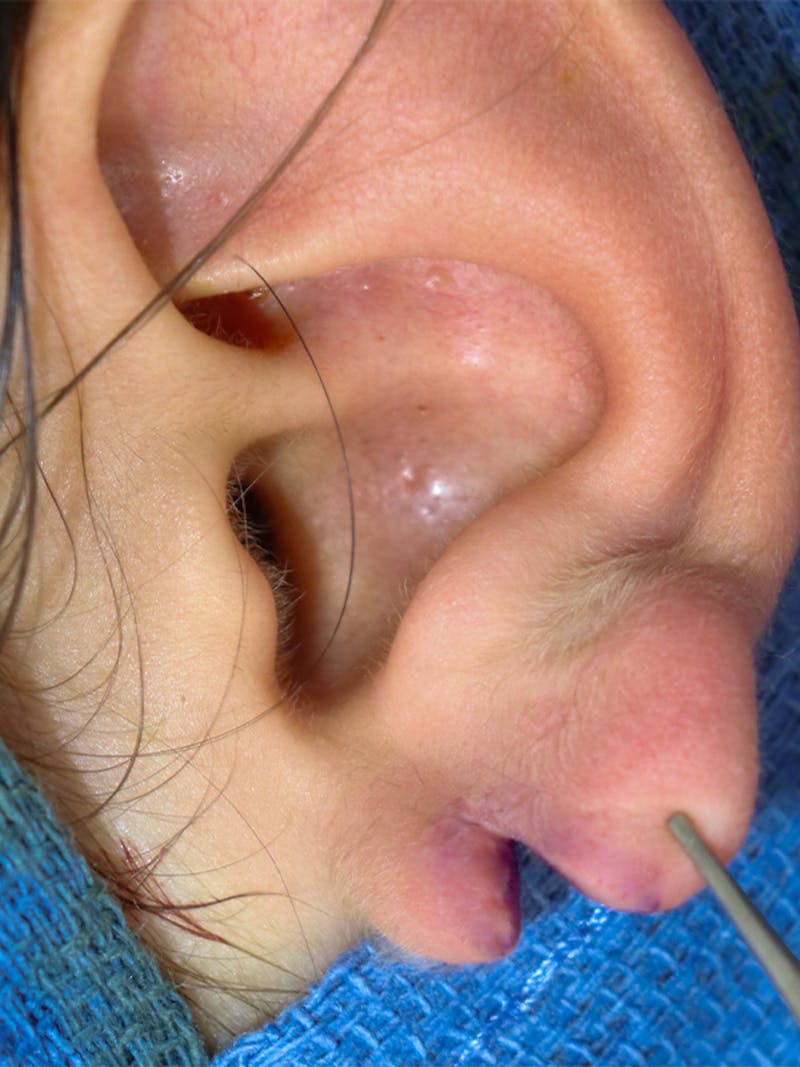 Earlobe Repair Before & After Gallery - Patient 331296 - Image 1