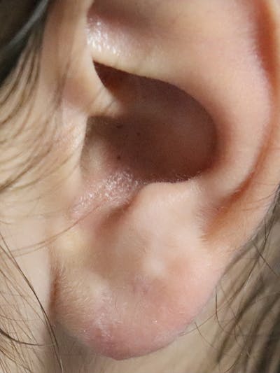 Earlobe Repair Before & After Gallery - Patient 331296 - Image 2