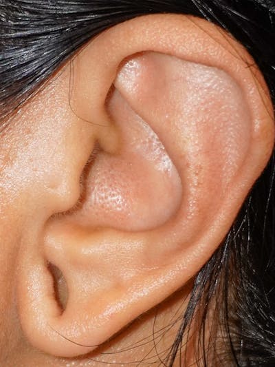 Earlobe Repair Before & After Gallery - Patient 269878 - Image 1